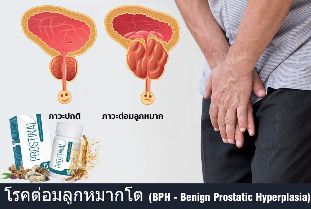 Prostinal- โรคต่อมลูกหมากโต -BPH - Benign Prostatic Hyperplasia
