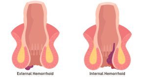 Hemorrhoid