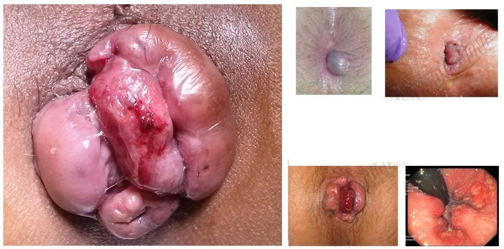 ริดสีดวงทวาร Hemorrhoids