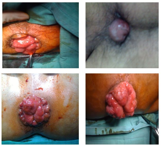 ริดสีดวงทวาร Hemorrhoids