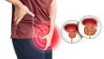 Benign Prostatic Hyperplasia