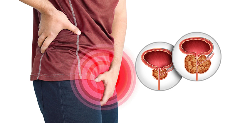 Benign Prostatic Hyperplasia