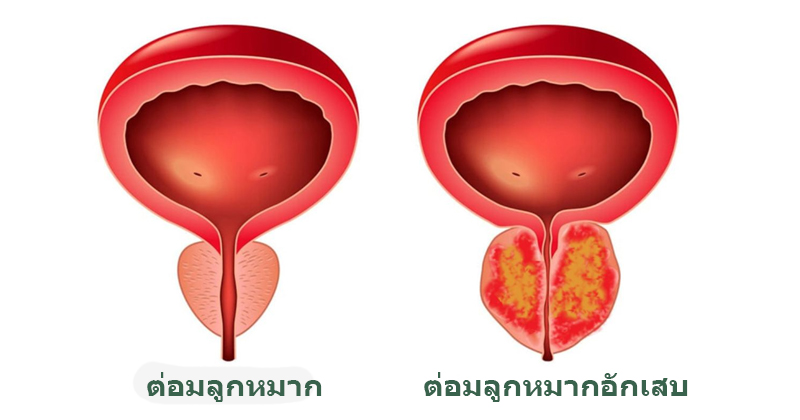 ต่อมลูกหมากอักเสบ