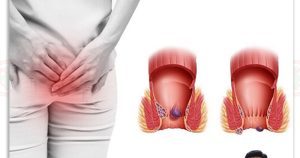 แยกความแตกต่างริดสีดวงทวารยื่น กับ ไส้ตรงปลิ้น สังเกตอย่างไรให้ถูกต้อง