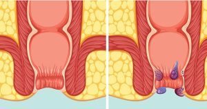รู้ว่าริดสีดวงทวารระยะต้นต้องผ่าตัดหรือไม่ พร้อมวิธีรักษาแบบไม่ผ่าตัดและสัญญาณที่ควรพบแพทย์
