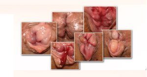 ริดสีดวงทวารภายนอกลิ่มเลือดอุดตัน: อาการ สาเหตุ และเมื่อไรควรไปโรงพยาบาล